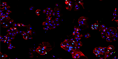 Parkinsons disease IPSCs